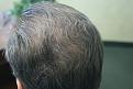 Click image for larger version

Name:	D RC 6mn post-op.jpg
Views:	680
Size:	25.5 KB
ID:	446037