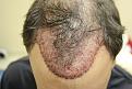 Click image for larger version

Name:	CA, immediate post-op2.jpg
Views:	1205
Size:	48.1 KB
ID:	446056