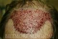 Click image for larger version

Name:	B Immed[1].post-op JSw.jpg
Views:	530
Size:	22.9 KB
ID:	446485