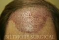 Click image for larger version

Name:	C 1 Wk[1].Post-op JSw.jpg
Views:	544
Size:	19.1 KB
ID:	446486