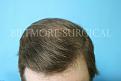 Click image for larger version

Name:	F 1Yr[1].10Months post-op JSw .jpg
Views:	573
Size:	96.7 KB
ID:	446489