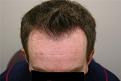 Click image for larger version

Name:	Pre-op Front.jpg
Views:	2195
Size:	25.0 KB
ID:	446673