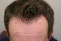 Click image for larger version

Name:	Pre-op front close-up.jpg
Views:	1761
Size:	26.4 KB
ID:	446674