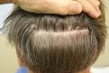 Click image for larger version

Name:	E, JT 1 yr scar.jpg
Views:	851
Size:	26.2 KB
ID:	446813