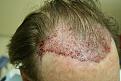 Click image for larger version

Name:	KB immedpostop3.jpg
Views:	620
Size:	89.2 KB
ID:	446864