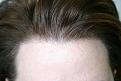 Click image for larger version

Name:	2010-0127    1 yr post op  ba 001.jpg
Views:	436
Size:	93.9 KB
ID:	447961