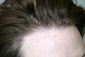 Click image for larger version

Name:	2010-0127    1 yr post op  ba 003.jpg
Views:	433
Size:	95.4 KB
ID:	447963