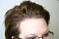 Click image for larger version

Name:	2010-0127    1 yr post op  ba 004.jpg
Views:	429
Size:	93.5 KB
ID:	447964