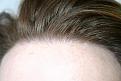 Click image for larger version

Name:	2010-0127    1 yr post op  ba 009.jpg
Views:	443
Size:	91.5 KB
ID:	447969