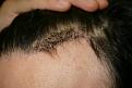 Click image for larger version

Name:	Date- (2009-0519)    Notes- post op  ba 001.jpg GOF.jpg
Views:	389
Size:	88.9 KB
ID:	448302