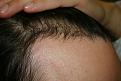 Click image for larger version

Name:	Date- (2009-0519)    Notes- post op  ba 002.jpg GOF.jpg
Views:	388
Size:	95.0 KB
ID:	448303