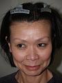 Click image for larger version

Name:	Before -hairline advancement.jpg
Views:	451
Size:	60.2 KB
ID:	449881