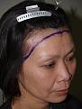 Click image for larger version

Name:	Before - hairline advancement 2.jpg
Views:	463
Size:	65.8 KB
ID:	449882