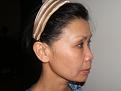 Click image for larger version

Name:	After - hairline advancement.jpg
Views:	493
Size:	58.6 KB
ID:	449884