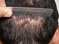 Click image for larger version

Name:	Donor site incision.jpg
Views:	551
Size:	98.4 KB
ID:	450301