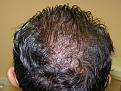 Click image for larger version

Name:	one day post-op 02.jpg
Views:	375
Size:	97.7 KB
ID:	450569