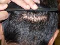 Click image for larger version

Name:	donor area post-op.jpg
Views:	366
Size:	99.0 KB
ID:	450578
