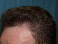 Click image for larger version

Name:	1 year post-op 03.jpg
Views:	429
Size:	95.4 KB
ID:	450657
