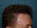 Click image for larger version

Name:	1 year post-op 04.jpg
Views:	438
Size:	95.1 KB
ID:	450658