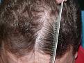 Click image for larger version

Name:	1 year post-op 08.jpg
Views:	434
Size:	97.7 KB
ID:	450662