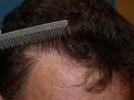 Click image for larger version

Name:	1 year post-op 12.jpg
Views:	418
Size:	95.7 KB
ID:	450666