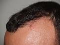Click image for larger version

Name:	After Hairline Left.jpg
Views:	347
Size:	95.8 KB
ID:	450699