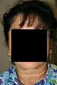 Click image for larger version

Name:	Date- (2010-0721)    Notes- 2 yrs post op  ba 001.jpg
Views:	462
Size:	81.0 KB
ID:	450748