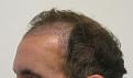 Click image for larger version

Name:	3a leftside 1 week after.jpg
Views:	322
Size:	72.7 KB
ID:	450784