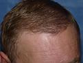 Click image for larger version

Name:	1 year post-op 04.jpg
Views:	550
Size:	92.2 KB
ID:	450805