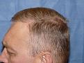 Click image for larger version

Name:	1 year post-op 05.jpg
Views:	515
Size:	96.0 KB
ID:	450806