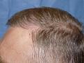 Click image for larger version

Name:	1 year post-op 06.jpg
Views:	507
Size:	96.3 KB
ID:	450807