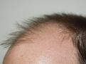 Click image for larger version

Name:	Before Hairline.jpg
Views:	517
Size:	89.1 KB
ID:	450903