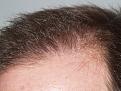 Click image for larger version

Name:	After Hairline.jpg
Views:	545
Size:	96.8 KB
ID:	450905