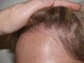 Click image for larger version

Name:	After Hairline.jpg
Views:	375
Size:	48.3 KB
ID:	450941