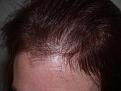 Click image for larger version

Name:	Before Hairline.jpg
Views:	377
Size:	95.7 KB
ID:	451006