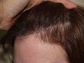 Click image for larger version

Name:	After Hairline.jpg
Views:	376
Size:	94.6 KB
ID:	451009