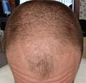 Click image for larger version

Name:	Pre-op top.jpg
Views:	720
Size:	44.2 KB
ID:	451018