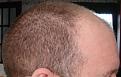 Click image for larger version

Name:	Pre-op right.jpg
Views:	589
Size:	54.3 KB
ID:	451022