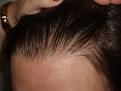 Click image for larger version

Name:	After Hairline.jpg
Views:	424
Size:	95.1 KB
ID:	451054