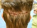 Click image for larger version

Name:	after surgery 05.jpg
Views:	448
Size:	96.4 KB
ID:	451128