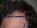 Click image for larger version

Name:	Before Hairline.jpg
Views:	442
Size:	96.7 KB
ID:	451197