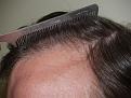 Click image for larger version

Name:	After Hairline.jpg
Views:	335
Size:	95.6 KB
ID:	451201