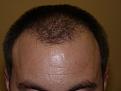 Click image for larger version

Name:	2 weeks post-op 01.jpg
Views:	383
Size:	43.2 KB
ID:	451244