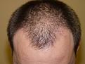 Click image for larger version

Name:	2 weeks post-op 02.jpg
Views:	394
Size:	58.3 KB
ID:	451245