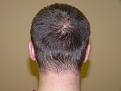 Click image for larger version

Name:	2 weeks post-op 03.jpg
Views:	402
Size:	43.6 KB
ID:	451246