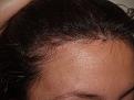 Click image for larger version

Name:	After Hairline 2.jpg
Views:	442
Size:	48.0 KB
ID:	451427