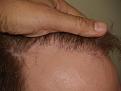 Click image for larger version

Name:	After Hairline.jpg
Views:	381
Size:	98.7 KB
ID:	451461