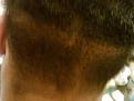 Click image for larger version

Name:	scar after 1sT HT.jpg
Views:	728
Size:	94.2 KB
ID:	451463