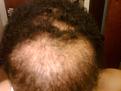 Click image for larger version

Name:	front hairline.jpg
Views:	662
Size:	95.8 KB
ID:	451464
