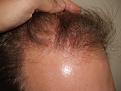 Click image for larger version

Name:	After Hairline.jpg
Views:	384
Size:	96.0 KB
ID:	451731